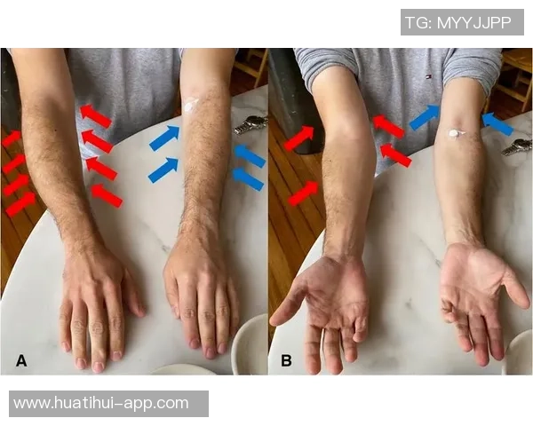 李磊右大腿后群肌肉拉伤及肌筋膜炎I的伤情报告分析与康复建议